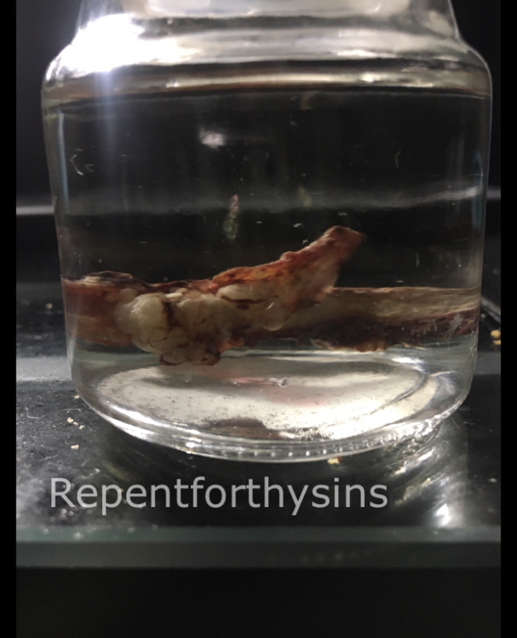 Flesh removed from my body.