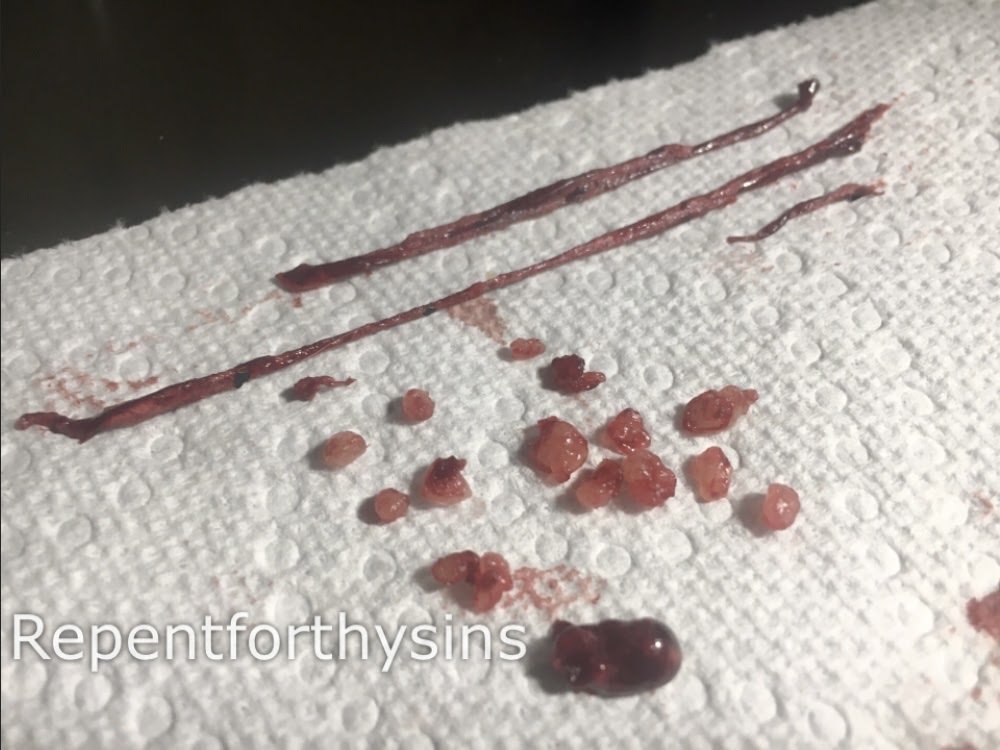 Flesh removed from my body.