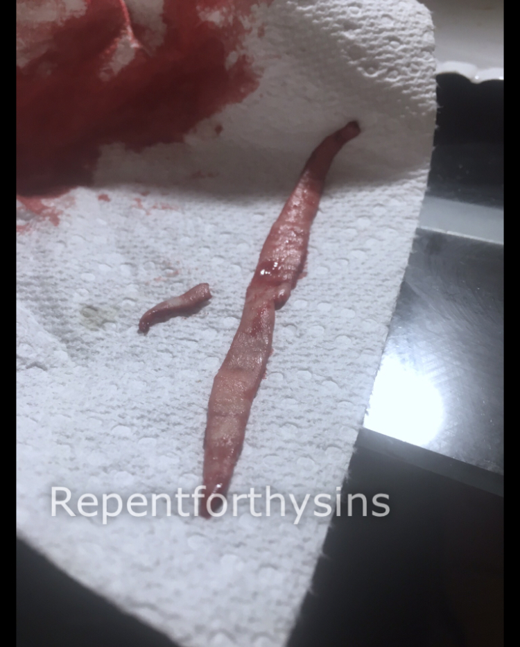 Flesh removed from my body.