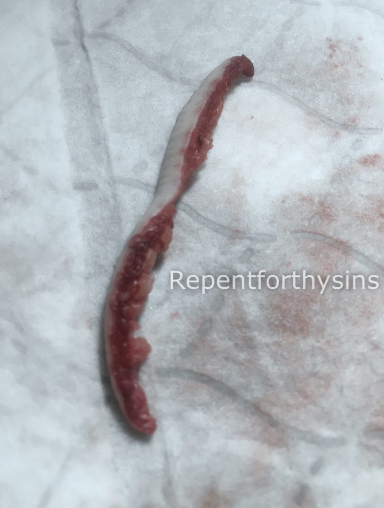 Flesh removed from my body.