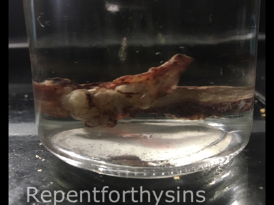 Flesh removed from my body