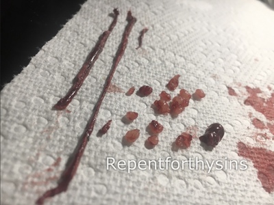 Flesh removed from my body