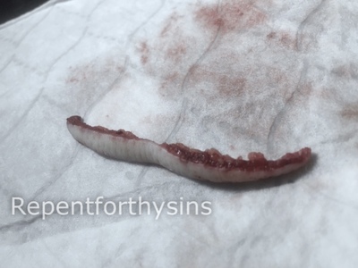 Flesh removed from my body