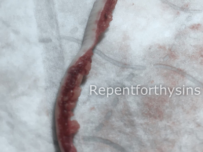 Flesh removed from my body