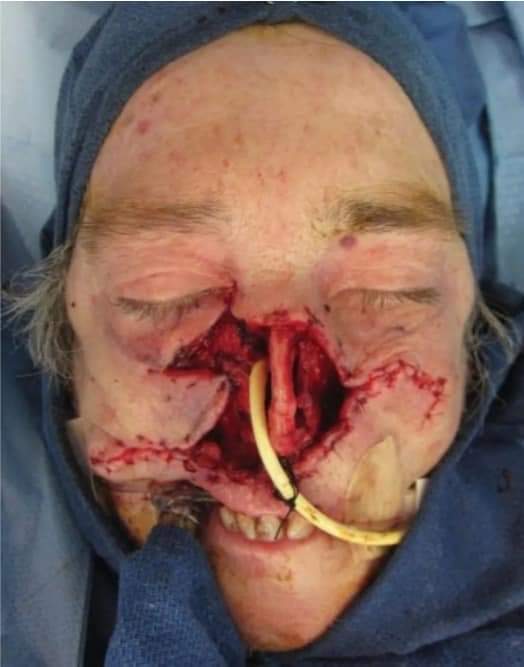71-year-old female patient who sustained a severe midface soft tissue