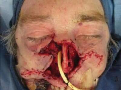 71-year-old female patient who sustained a severe midface soft tissue