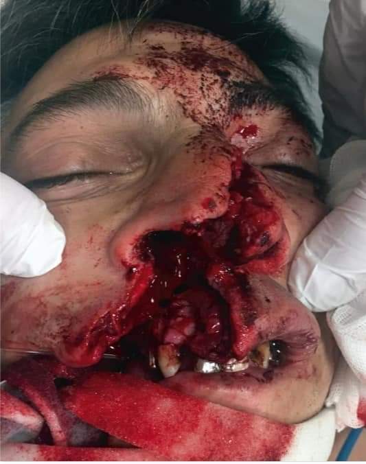 Angle Grinder Accident