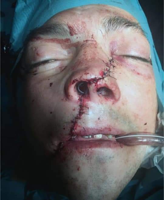 Angle Grinder Accident