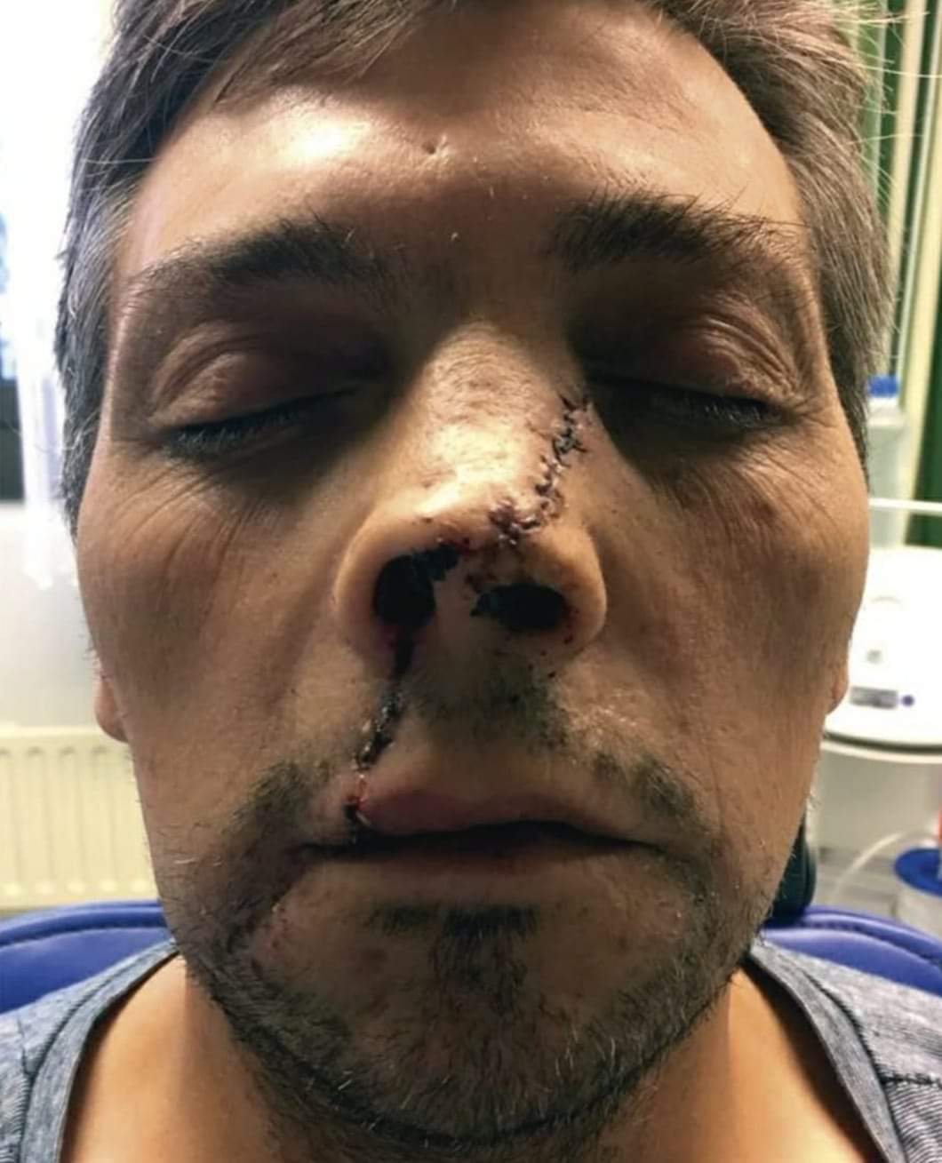 Angle Grinder Accident