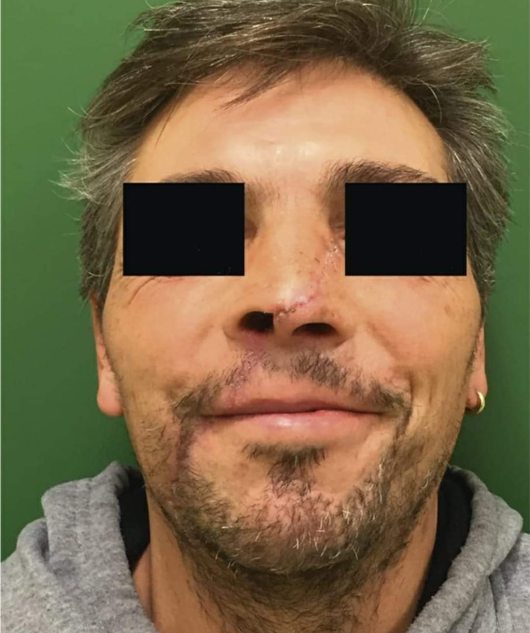 Angle Grinder Accident