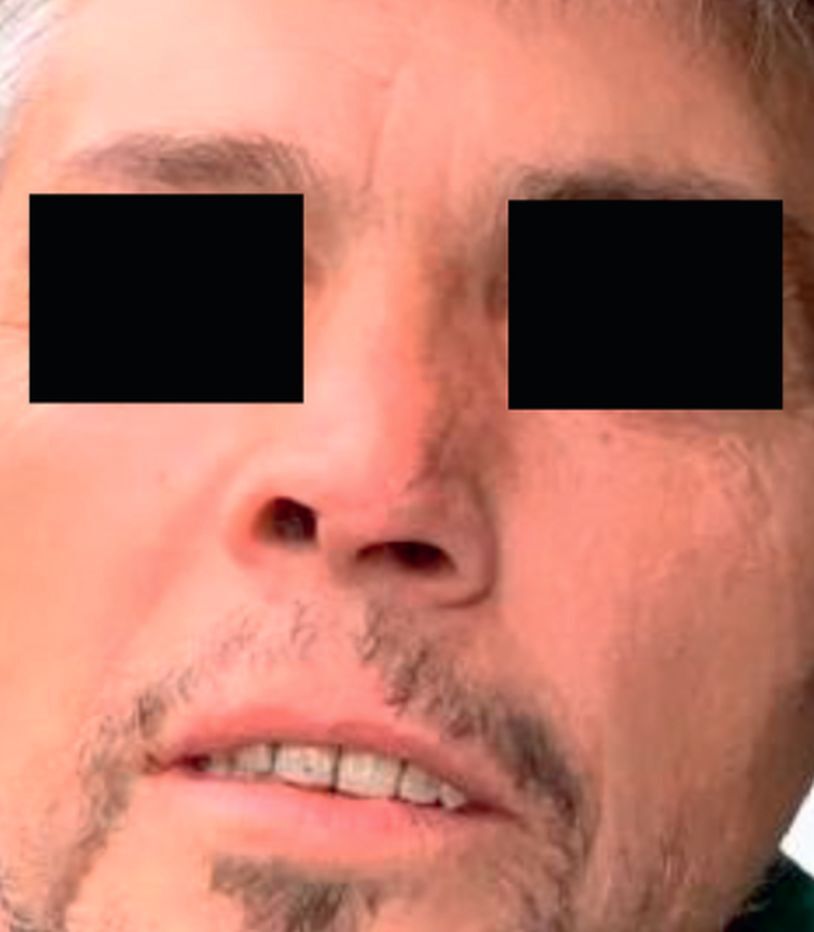 Angle Grinder Accident