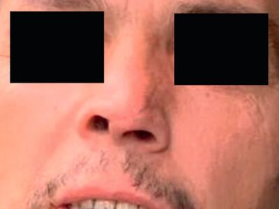 Angle Grinder Accident