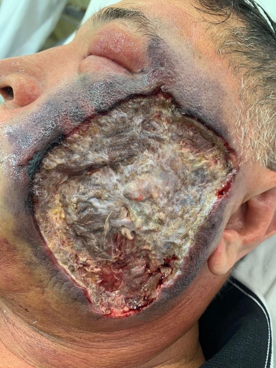 Brazil- Naldo suffered from a necrotizing skin condition died at 30.