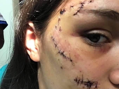 18 Yr Old Argentinian Face Mauled By Dog