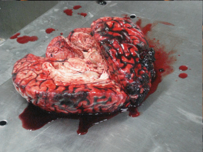 Female autopsy in Brazil 