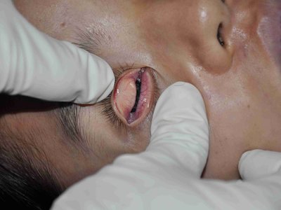 Autposy: Young asian female examined