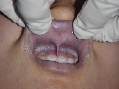 Autposy: Young asian female examined