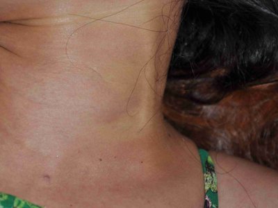 Autposy: Young asian female examined