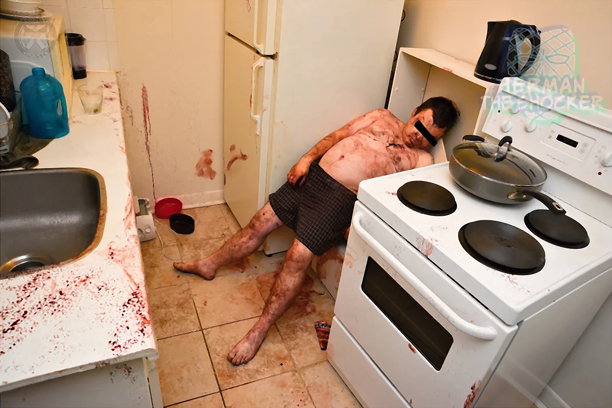 Fatal Bleeding From A Laceration Of Superficial Temporal Artery