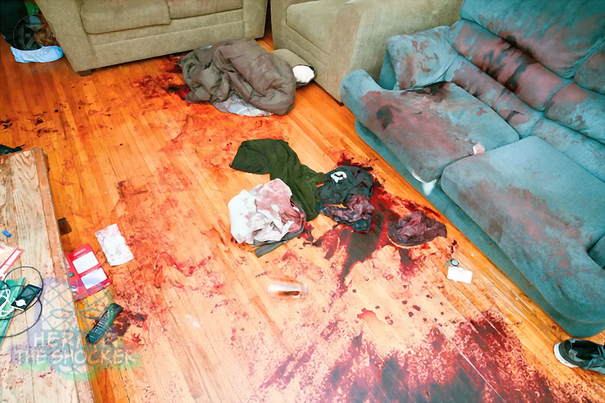 Fatal Bleeding From A Laceration Of Superficial Temporal Artery