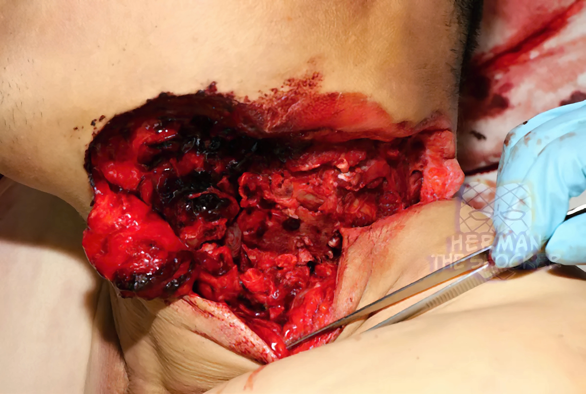 Man Commits Suicide By Cutting His Neck With A Cut-Off Saw