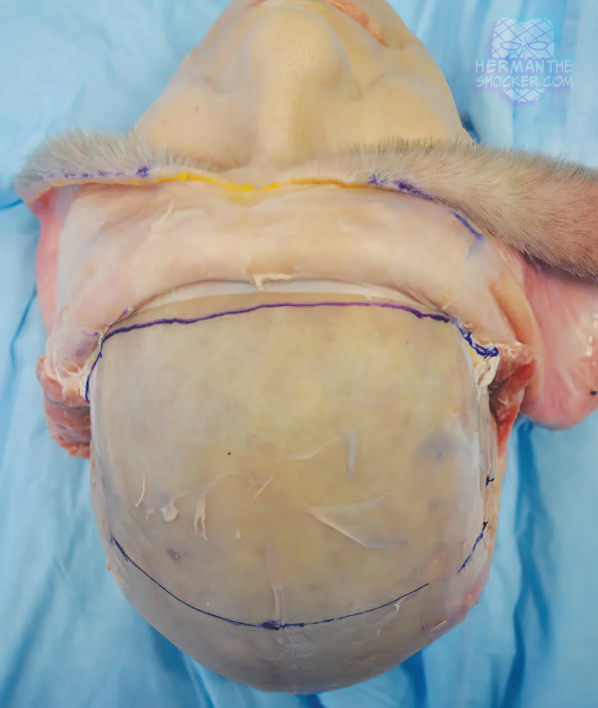 WTF: Facial Allograft Technique In Facial Reconstruction