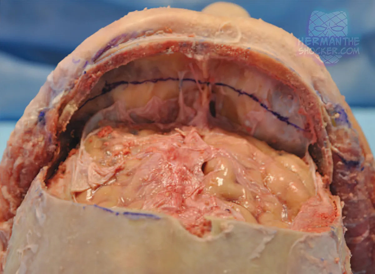 WTF: Facial Allograft Technique In Facial Reconstruction
