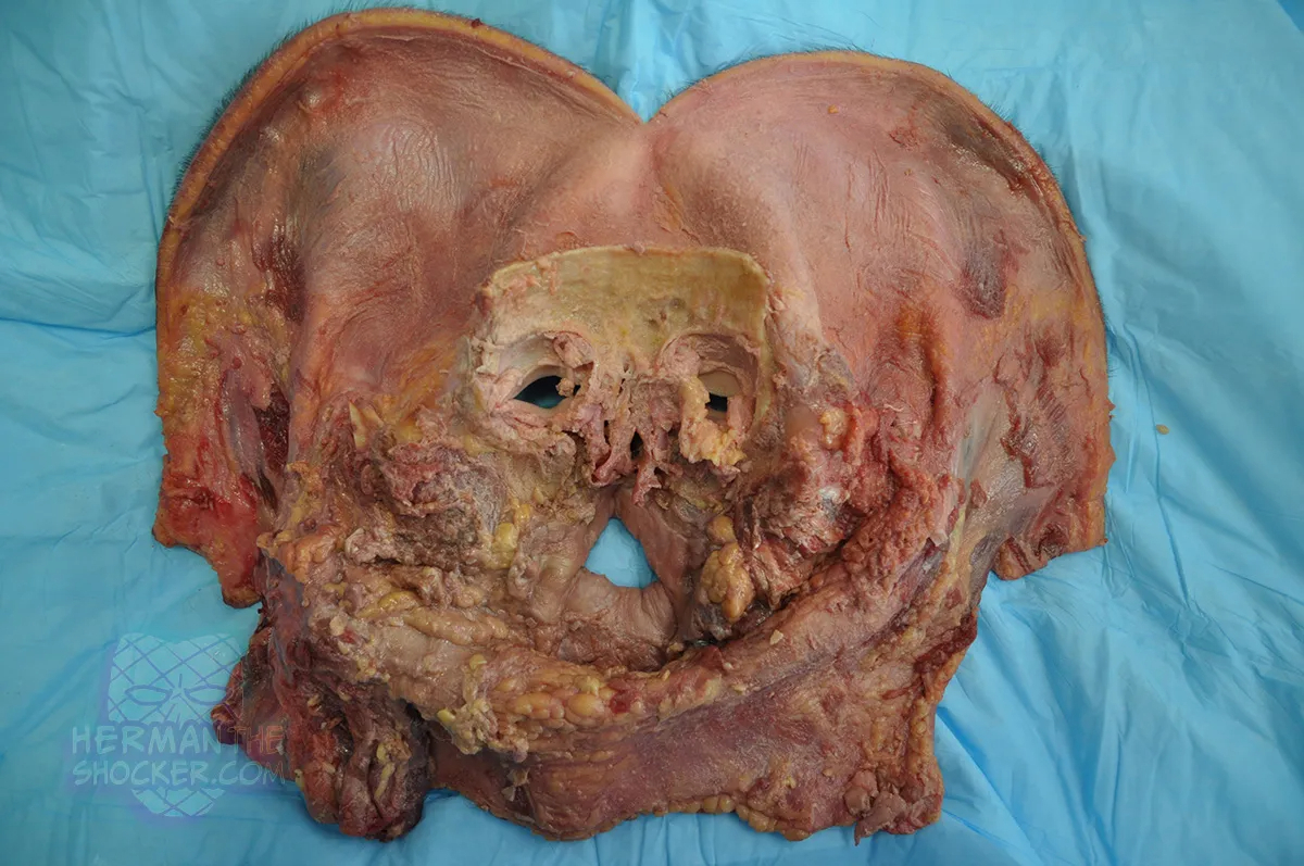 WTF: Facial Allograft Technique In Facial Reconstruction