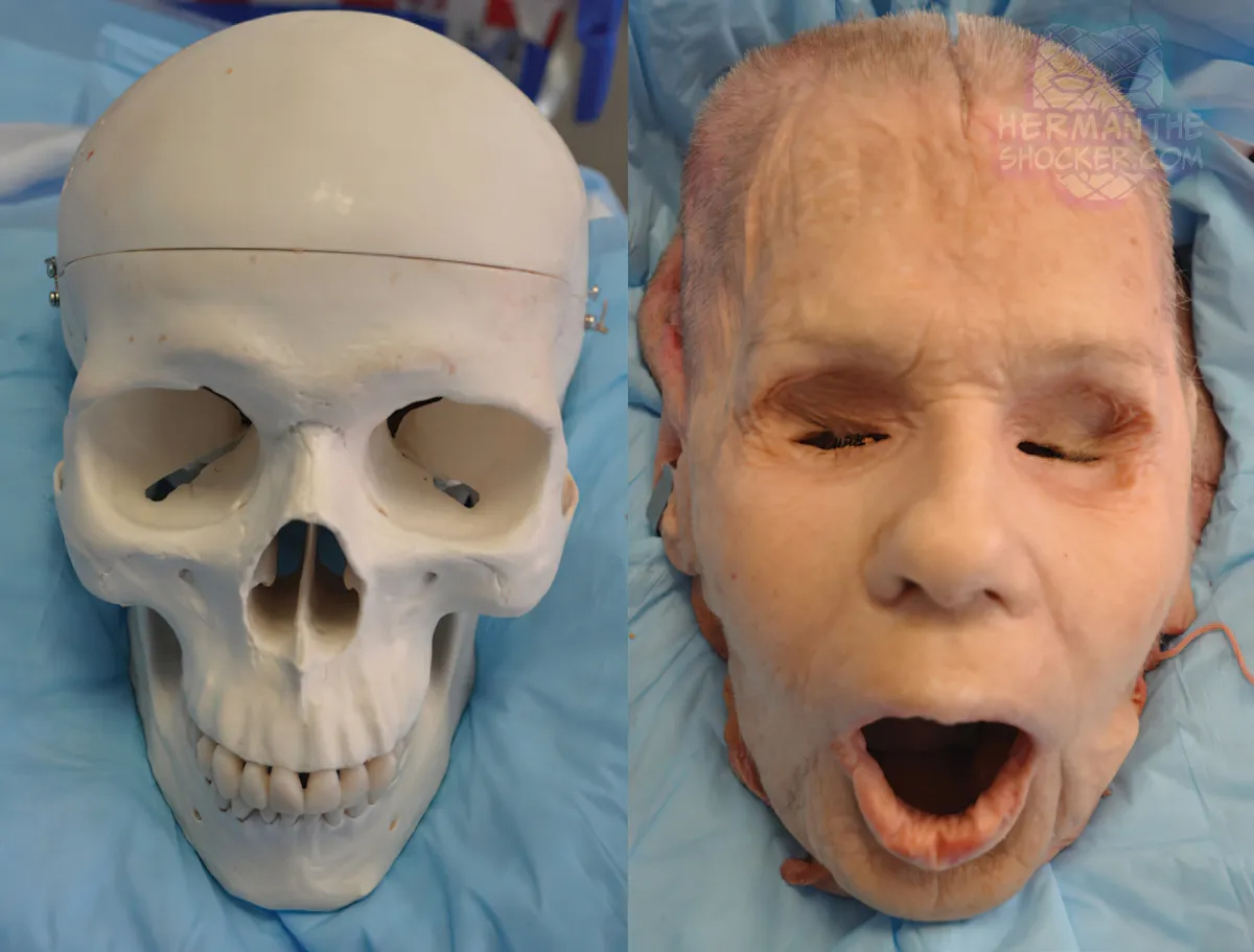 WTF: Facial Allograft Technique In Facial Reconstruction