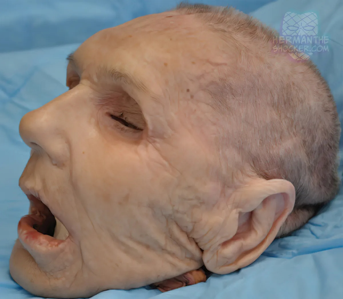 WTF: Facial Allograft Technique In Facial Reconstruction