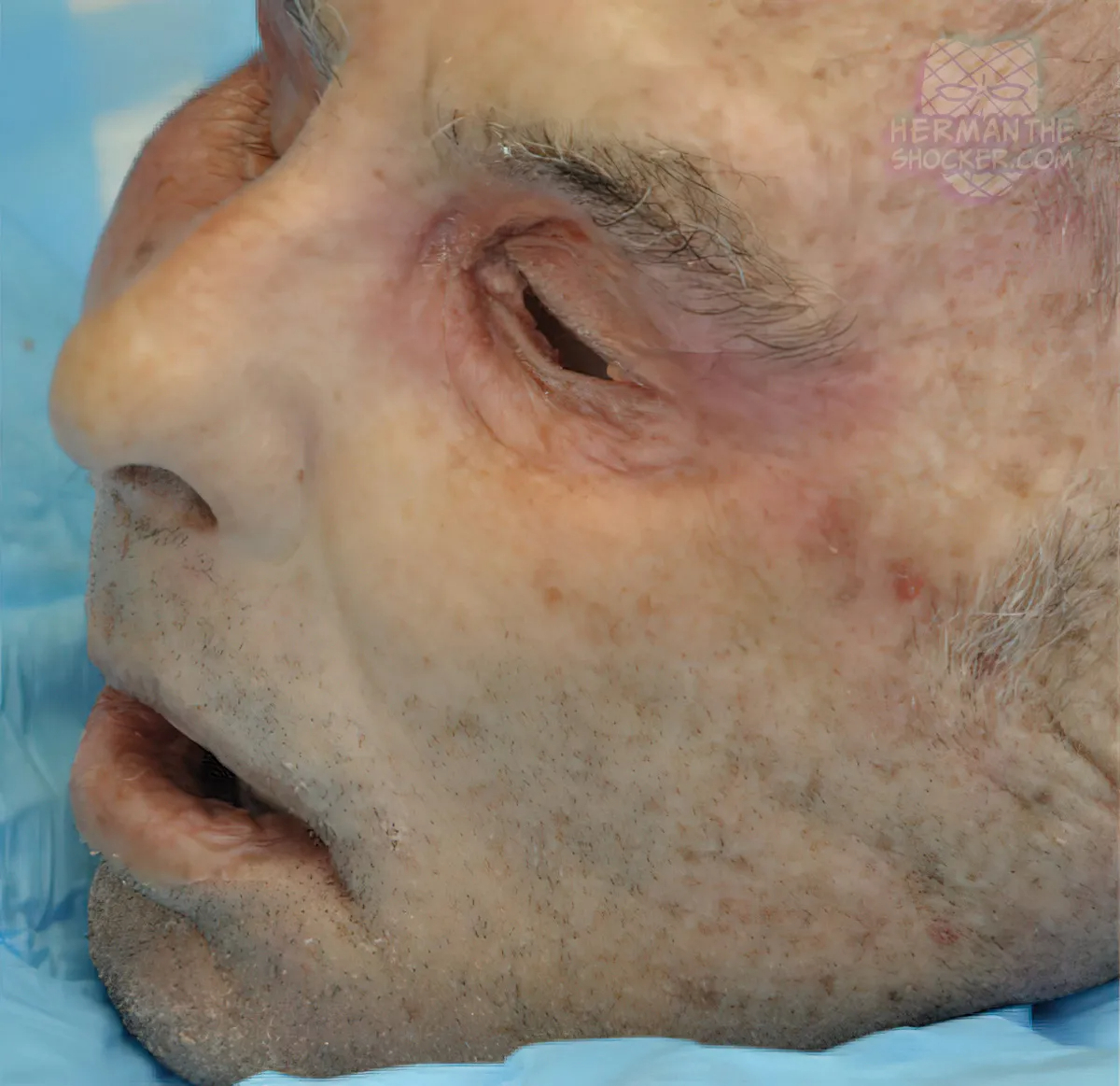 WTF: Facial Allograft Technique In Facial Reconstruction