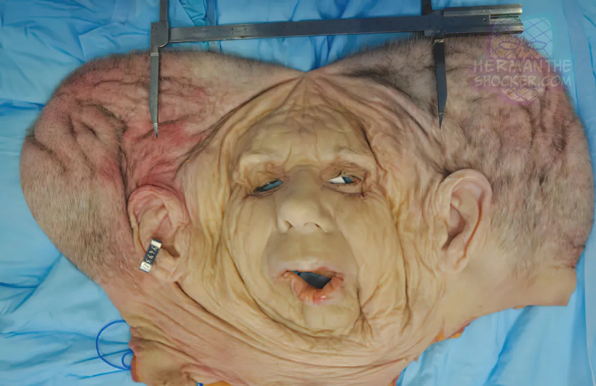 WTF: Facial Allograft Technique In Facial Reconstruction