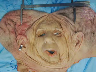 WTF: Facial Allograft Technique In Facial Reconstruction
