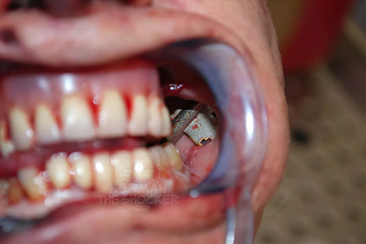 Patricide And Overkill