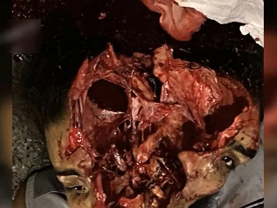  Dude cracks skull in motorcycle accident