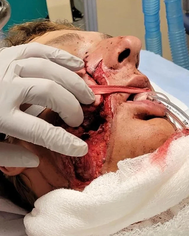 He survived a serious facial injury from a circular saw
