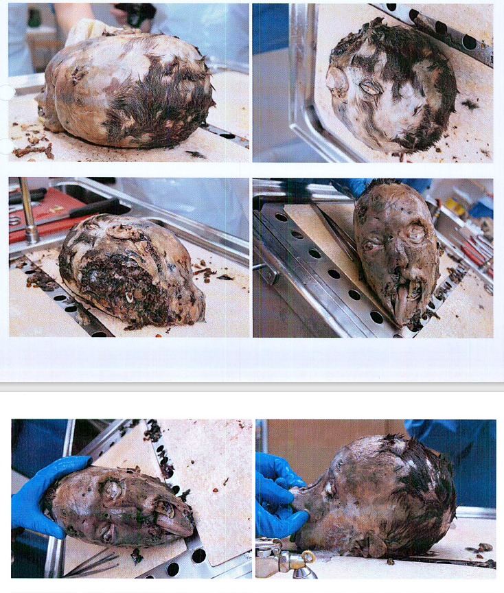 Autopsy images from Christian Larsson case