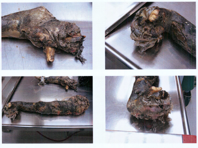 Autopsy images from Christian Larsson case