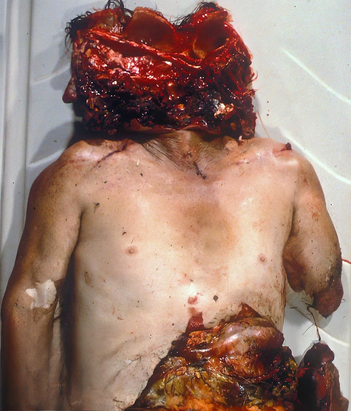 Fatal Chop Injuries After Falling Off A Tractor