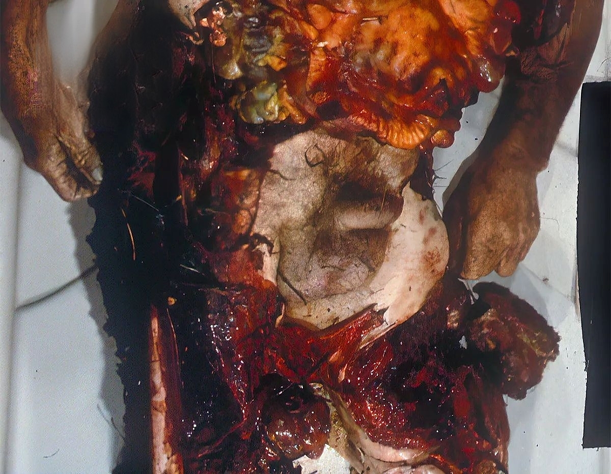 Fatal Chop Injuries After Falling Off A Tractor