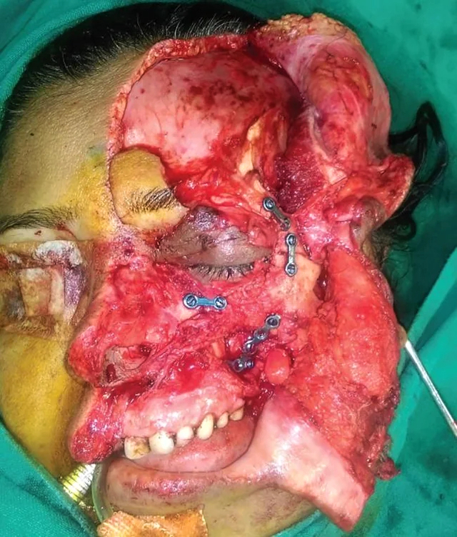 Facial avulsion
