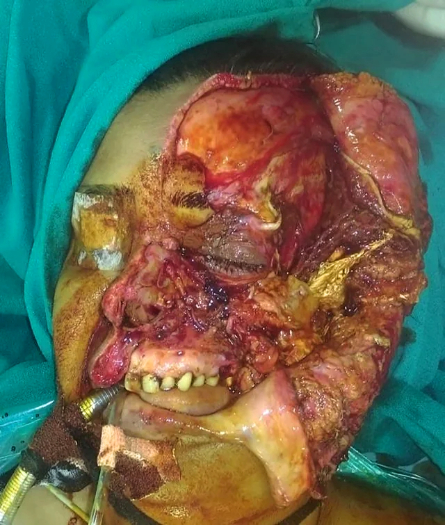 Facial avulsion