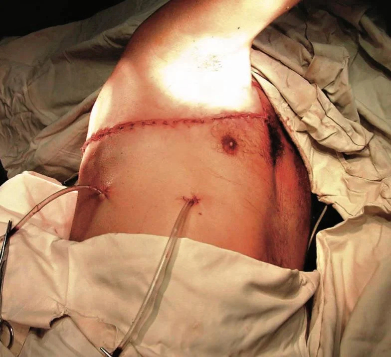 Complex thoracic impalement