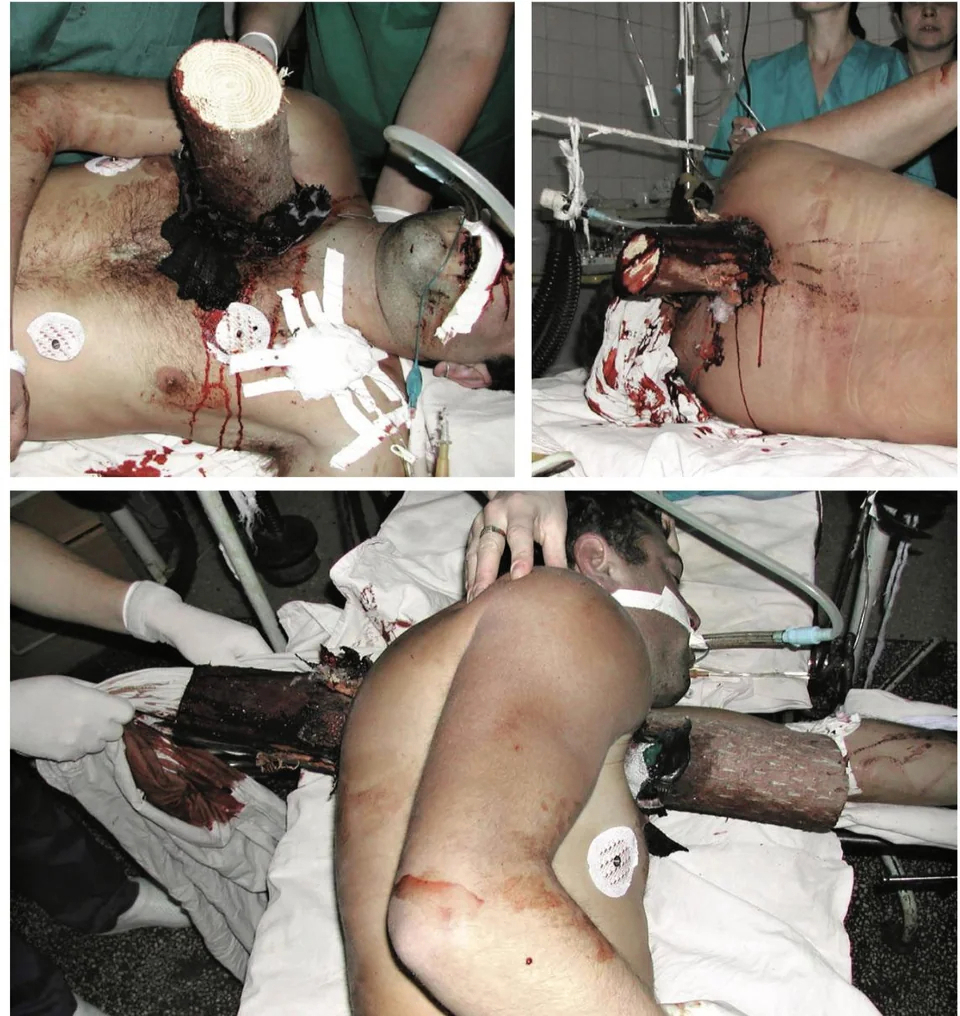 Complex thoracic impalement