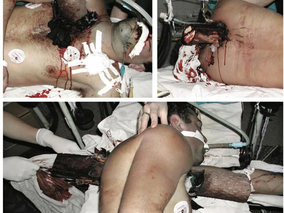 Complex thoracic impalement