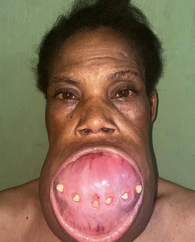 Removal of a mandibulectomy mass