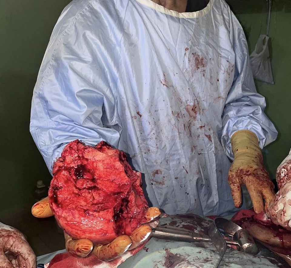 Removal of a mandibulectomy mass