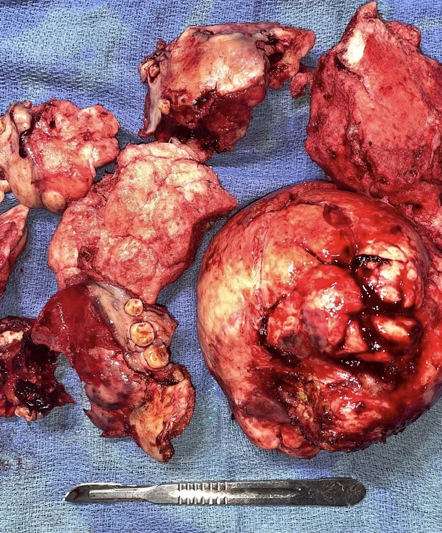Removal of a mandibulectomy mass
