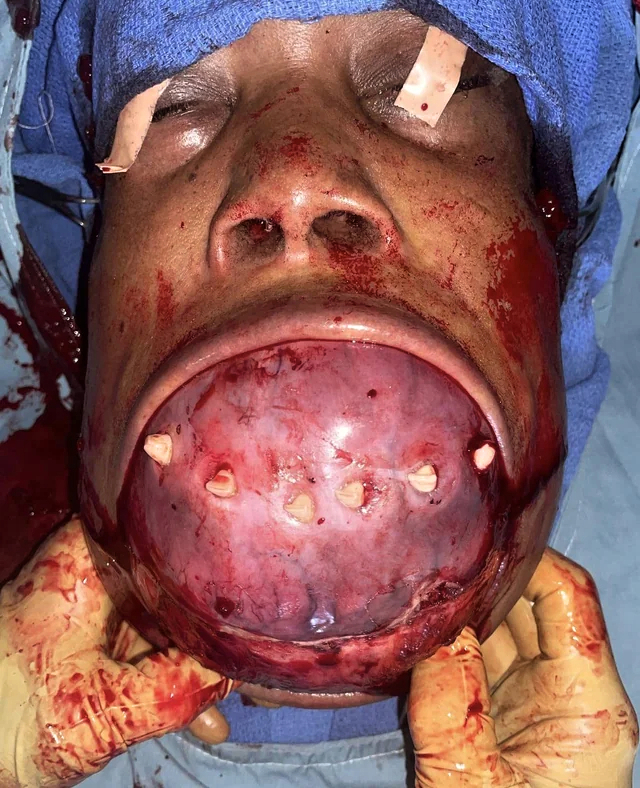 Removal of a mandibulectomy mass