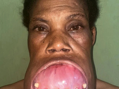 Removal of a mandibulectomy mass